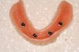 Snap on Denture