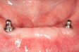 Dentures and Implants